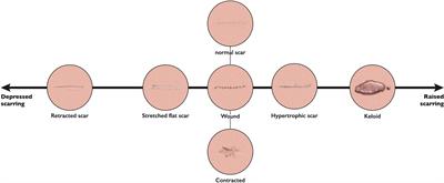 Skin scarring: Latest update on objective assessment and optimal management